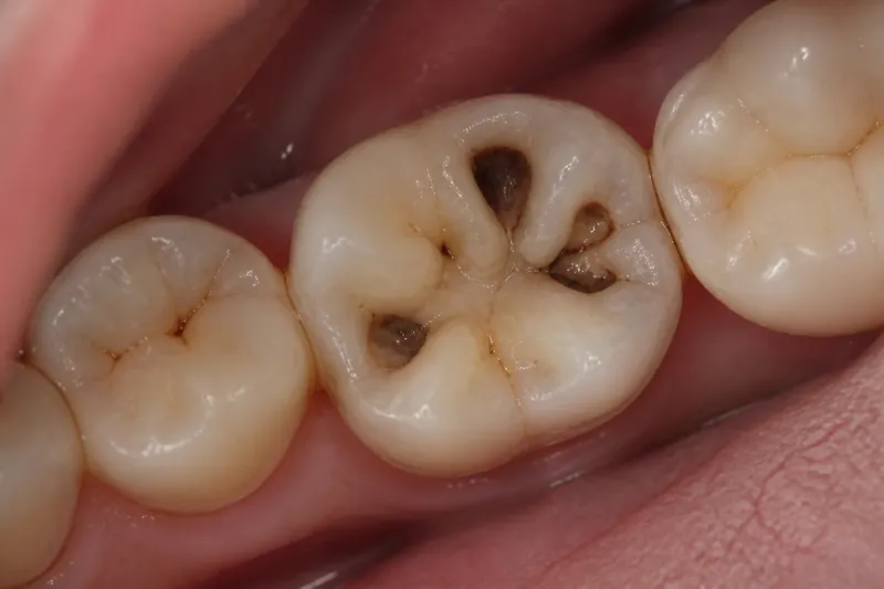 Close-up of molars with dark cavity pits in the chewing surface